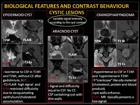 Figure From Imaging Of Pure Suprasellar Lesions Semantic Scholar