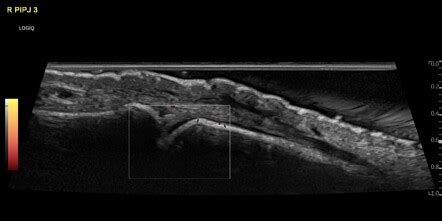 Knuckle Pads Image Radiopaedia Org