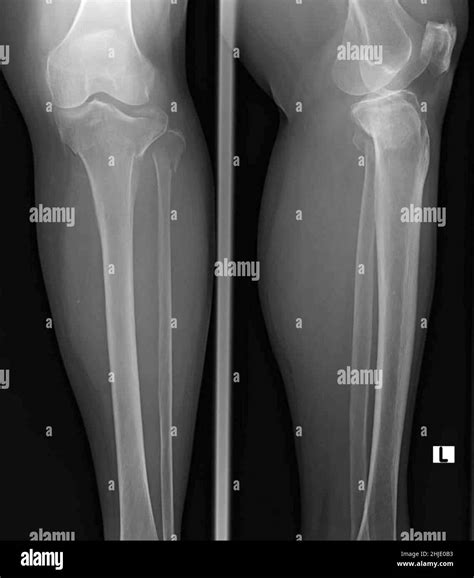 Fractured Tibia Hi Res Stock Photography And Images Alamy