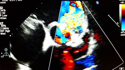 Echocardiogram - Ventricular septal defect - Supracristal (subarterial doubly committed). - YouTube