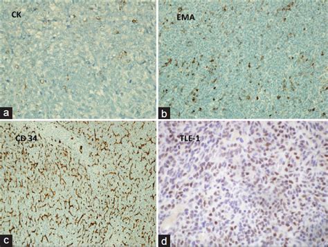 Primary Pulmonary Poorly Differentiated Synovial Sarcoma Transducer