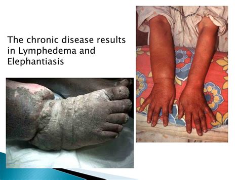 Ppt Lymphatic Filariasis Powerpoint Presentation Free Download Id