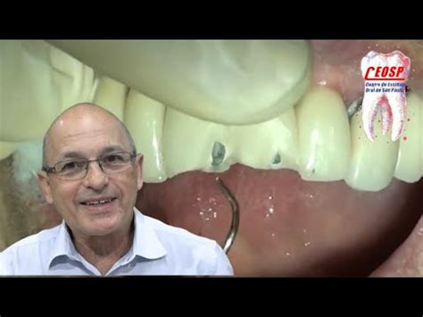 Como restaurar uma prótese fraturada de porcelana Dr Antônio Sérgio