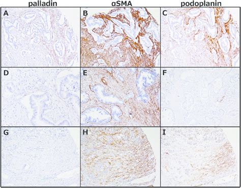 Immunohistochemical staining with palladin podoplanin and α SMA