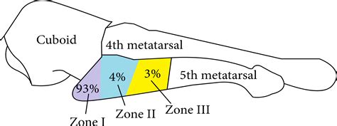 5th Metatarsal Fractures To Repair Or Rehab — Physio Network