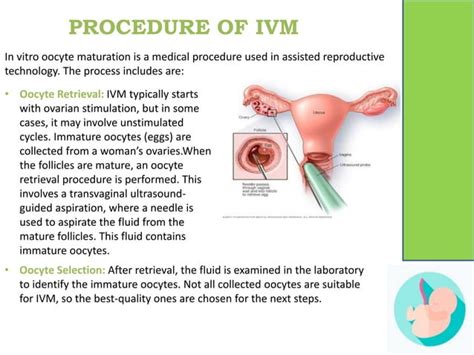 Ivm In Vitro Oocyte Maturation Pptx