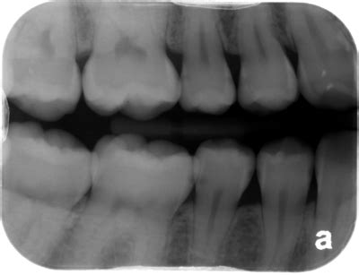 Caries Interpretation: Interproximal Caries Answers – Dr. G's Toothpix