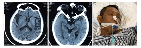 Craniocerebral Computed Tomography Scan Indicates Wide And Deep Download Scientific Diagram