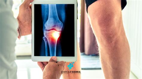 Es Bueno Andar Para La Artrosis De Rodilla Consejos