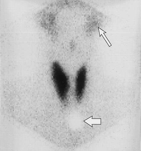 Scintigraphic Features Of Autoimmune Thyroiditis Radiographics