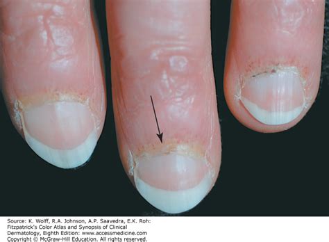 Debridement Of Nail Plate - Nail Ftempo