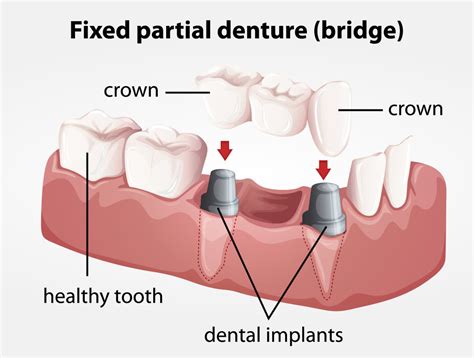 Fixed partial denture bridge