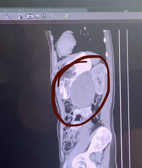 Ct Scan Of A Mass On My Pancreas Tail Radiology