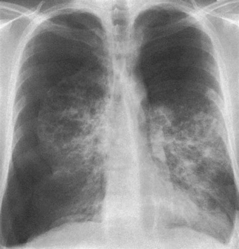 Hyperlucent Lung Radiology Key