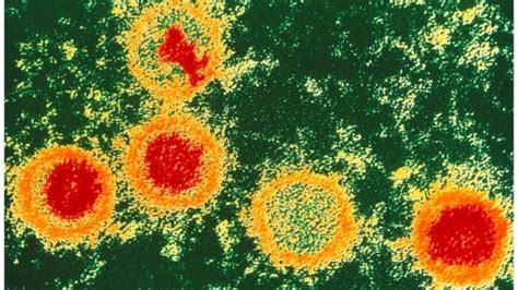 Epstein-Barr virus and cancer | Microbiology