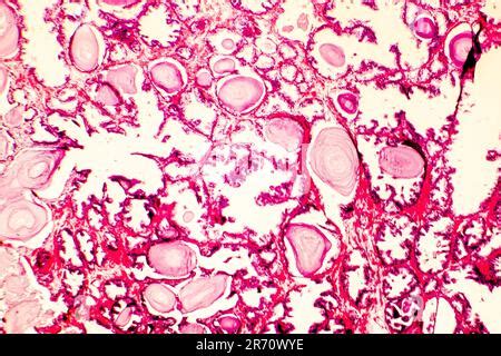 Hyperplasie De La Prostate Photomicrographe Montrant Les Glandes