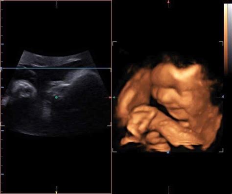 D D Ultrasound At Weeks Anterior Placenta March