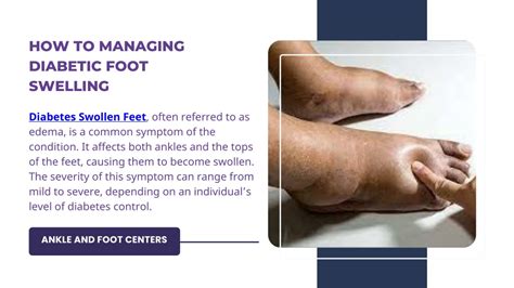 Ppt Managing Diabetic Foot Swelling Powerpoint Presentation Free