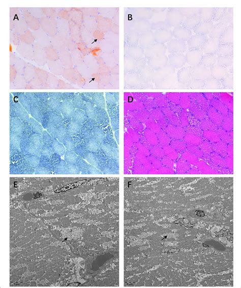 Figure E Muscle Biopsy Of The Quadriceps Femoris A Oil Red O Oro