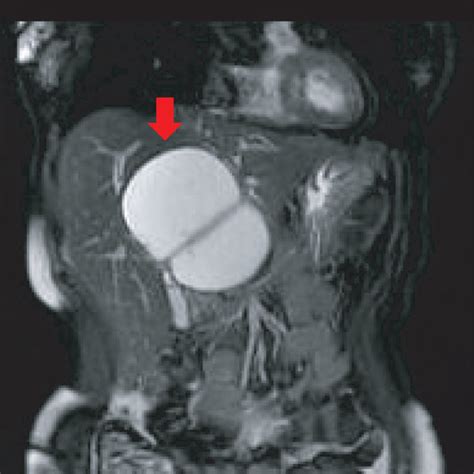 A Enhanced Computed Tomography And B T2 Weighted Magnetic Resonance