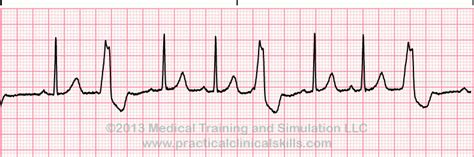 ECG Jeopardy! Jeopardy Template