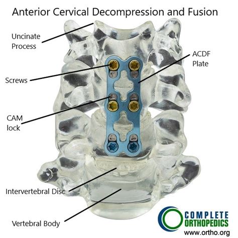 Types Of Anterior Cervical Fusion