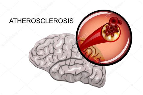 Atherosclerosis of brain vessels — Stock Vector © Artemida-psy #134144126