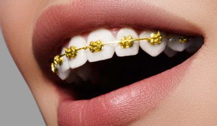 Braces in Pensacola | Smart Smiles Orthodontics