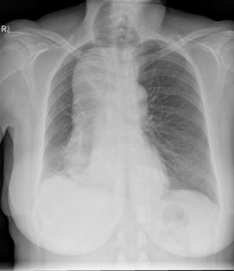 Achalasia Chest X Ray