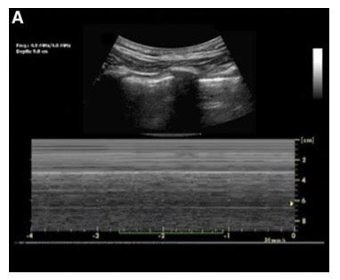 Lung Point Of Care Ultrasound Openanesthesia