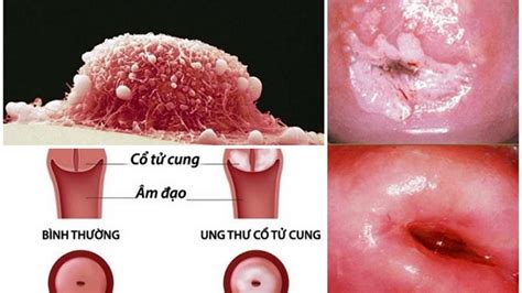 Viêm lộ tuyến bẩm sinh Nguyên nhân triệu chứng và điều trị