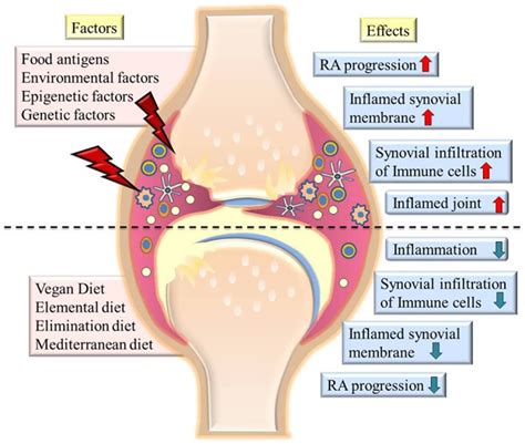 Rheumatoid Arthritis - Causes, Signs, Symptoms, Diet, Treatment