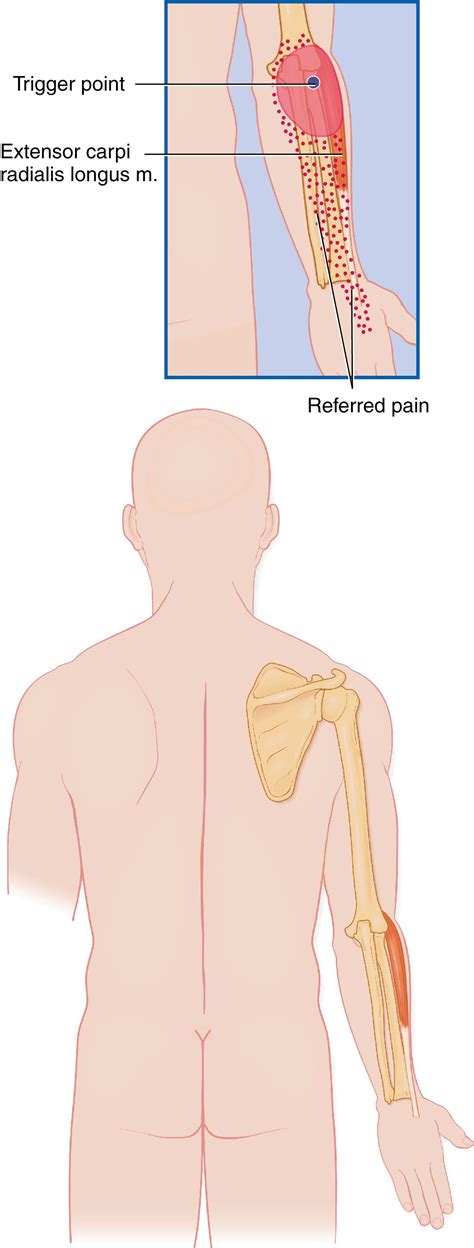 Injection Technique For Extensor Carpi Radialis Longus Syndrome Clinical Tree