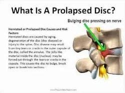 Prolapsed Disc at best price in Chennai by Total Rehab clinic | ID: 6960255630