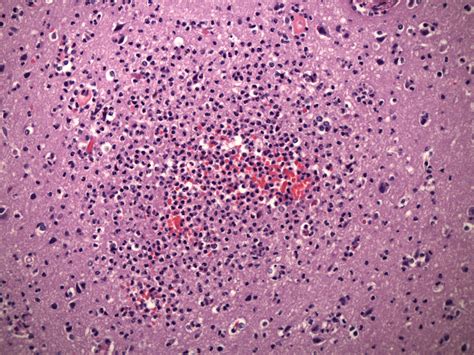 Abscess Histology