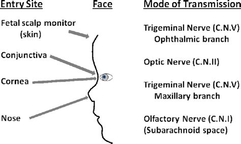 Figure 1 From Acute Retinal Necrosis Caused By Herpes Simplex Virus