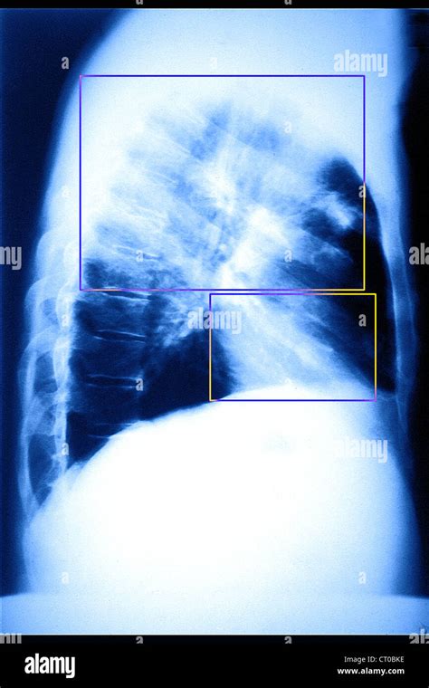 Lung x ray apparatus hi-res stock photography and images - Alamy