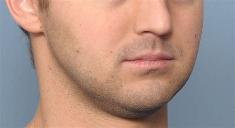 Male Jawline Implant Oblique 1 Dr Barry Eppley Explore Plastic Surgery