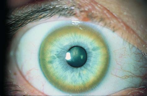 Кольцо кайзера - 91 фото