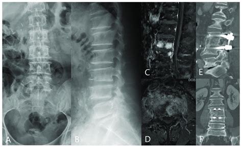 A 44−year−old man had lower back pain for more than 2 months. (A,B) The ...