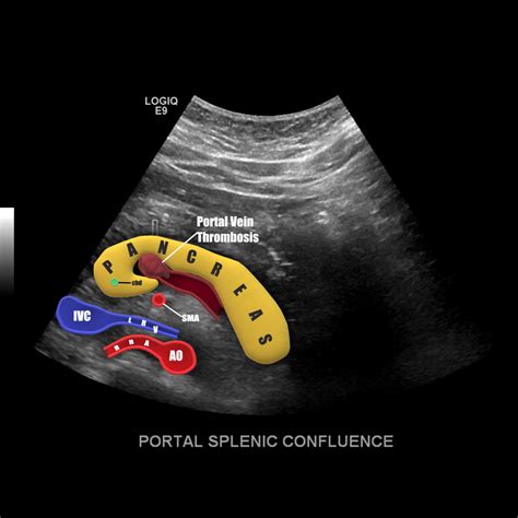 Splenic Vein Thrombosis