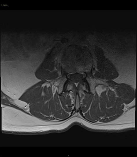 Metastatic Pancreatic Adenocarcinoma - Body MR Radiology Case Studies