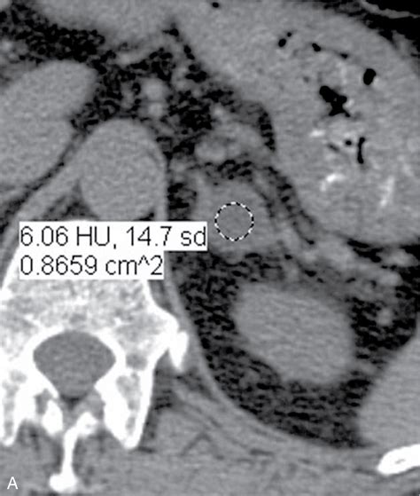 Adrenal Gland Enlargement And Nodules Clinical Tree