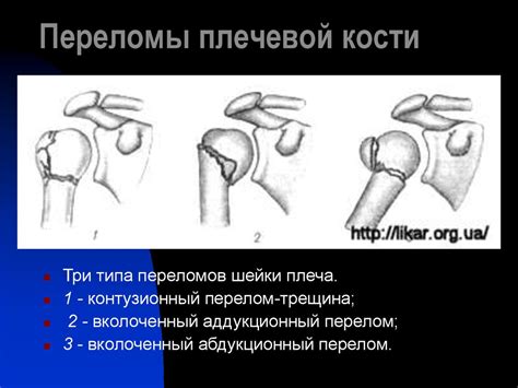 Переломы плечевой кости - презентация онлайн