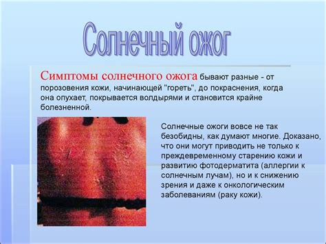 Ожоги. Виды ожогов. Солнечные ожоги. Тепловой удар - online presentation
