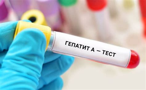 Cпалах гепатиту А в Україні: чи загрожує киянам - Вечірній Київ