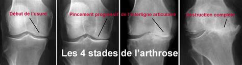 Arthrose Du Genou Dr Yves Rouxel