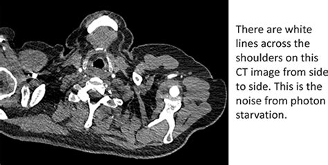 Ct Artefacts Radiology Cafe