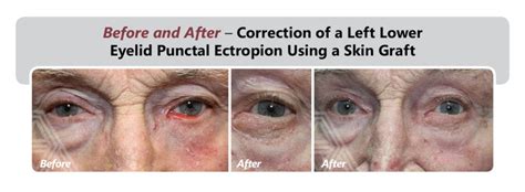 Ectropion Repair Triad Eye Institute