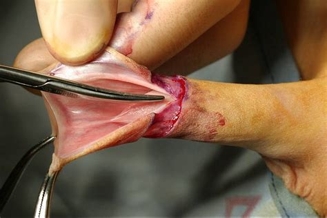 Circumcised Vagina